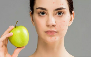 Dealing with Acne: Managing Through Skincare