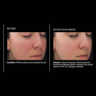 PCA | Dual Action Redness Relief
